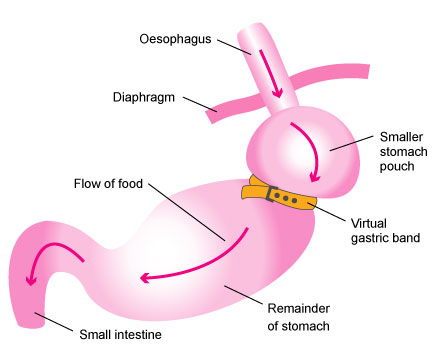 gastricband